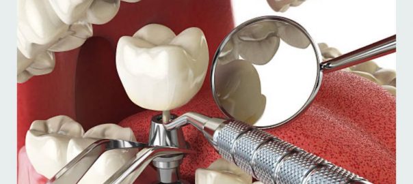 dental implant in Delhi