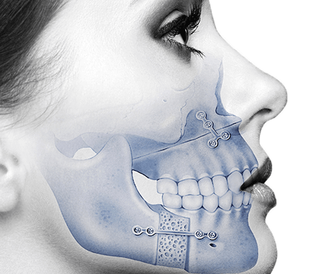 orthognathic surgery