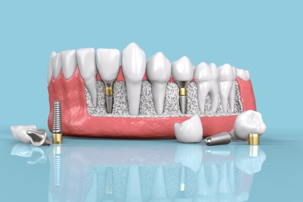 dental implants