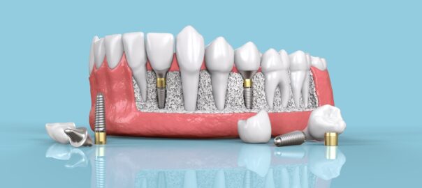 dental implants